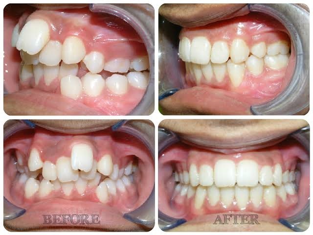 Braces & Clipping (Orthodontics), Sanjeevani Dental Clinic, Dentist, Orthodontist, Dental Clinic, Dental Services